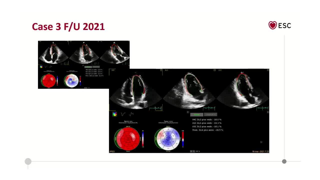 ESC Webinars Series - Sports Cardiology. Focus on athlete's heart vs. cardiomyopathy: the role of imaging