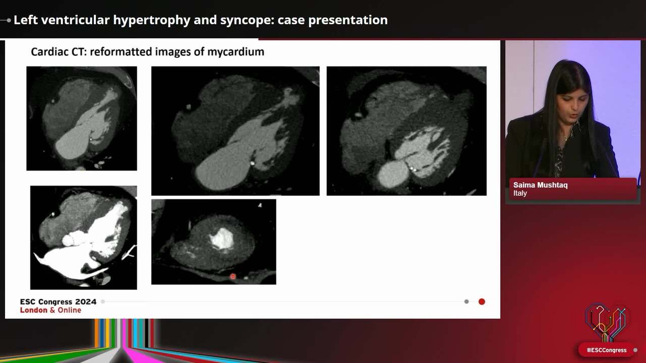 Left ventricular hypertrophy and syncope: case presentation